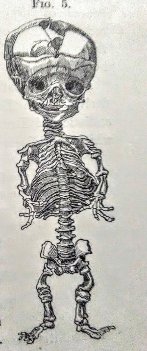 infant skeleton with rickets 1881